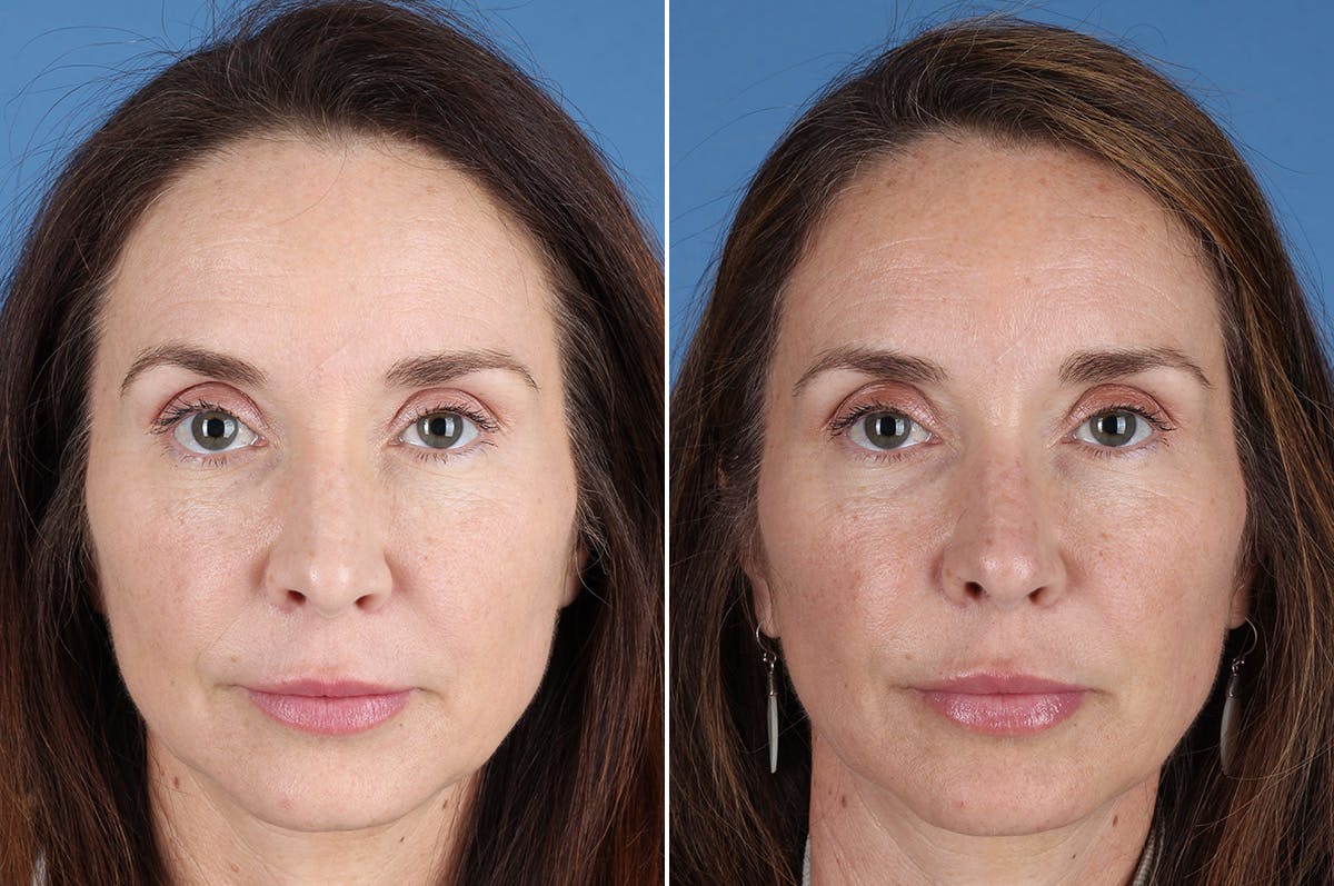 Revision Rhinoplasty Before & After Gallery - Patient 361799 - Image 2