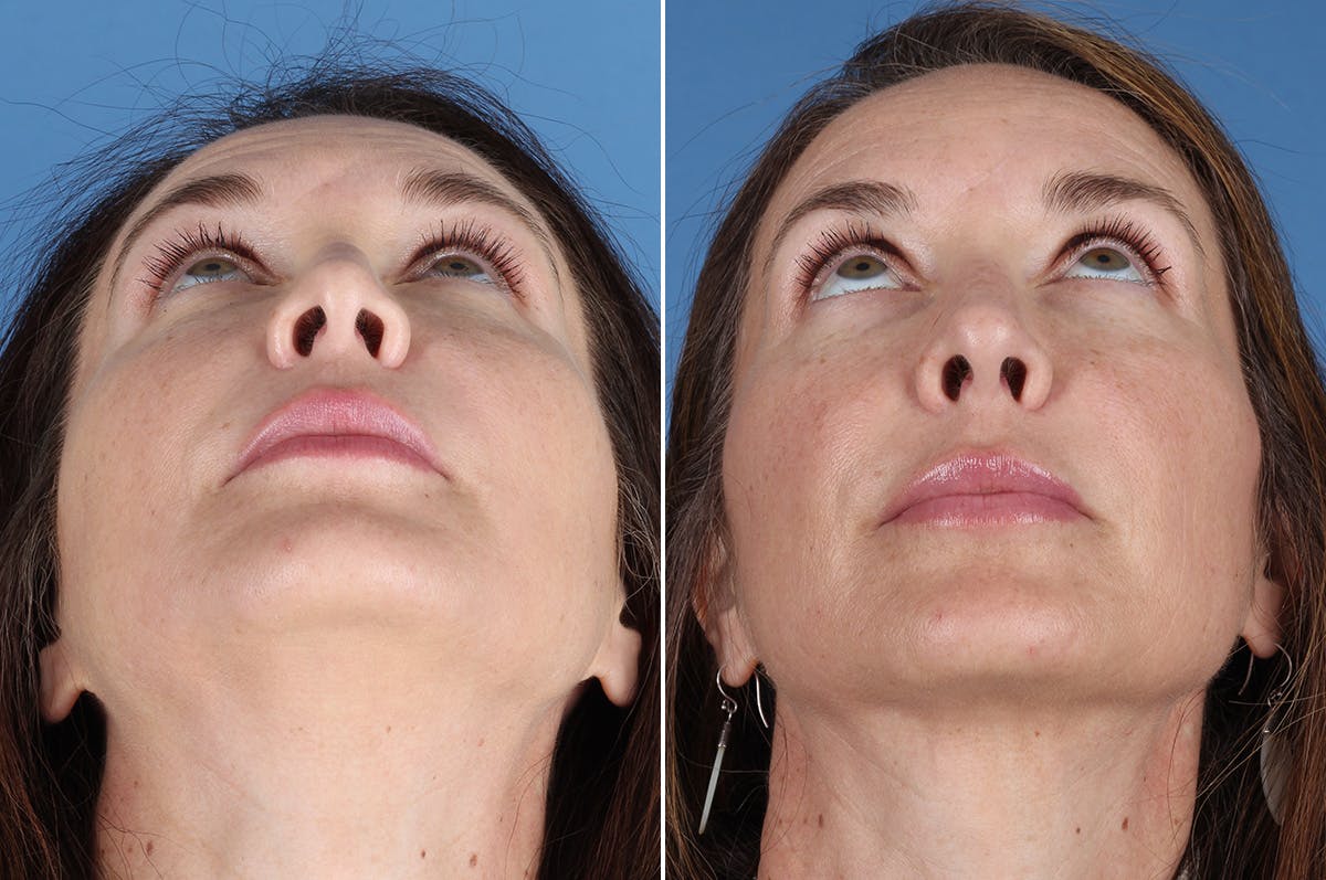 Revision Rhinoplasty Before & After Gallery - Patient 361799 - Image 3