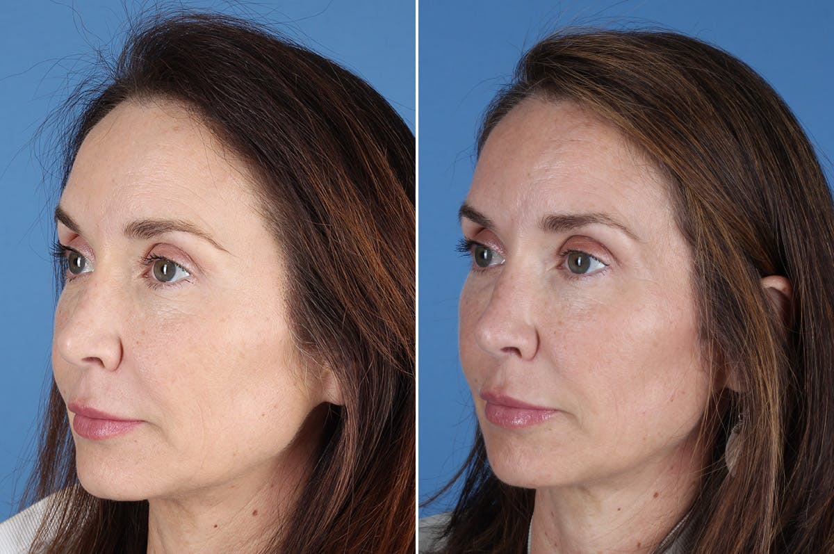 Revision Rhinoplasty Before & After Gallery - Patient 361799 - Image 4
