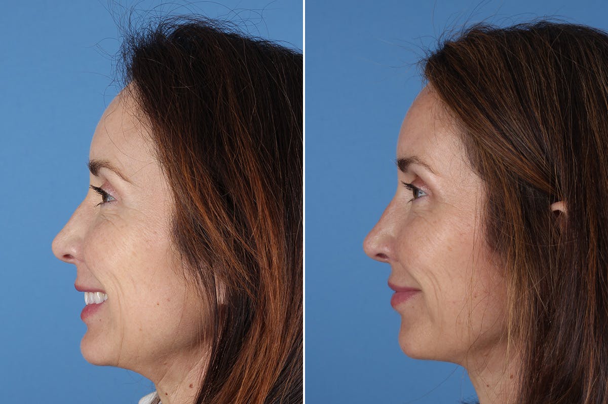 Revision Rhinoplasty Before & After Gallery - Patient 361799 - Image 6