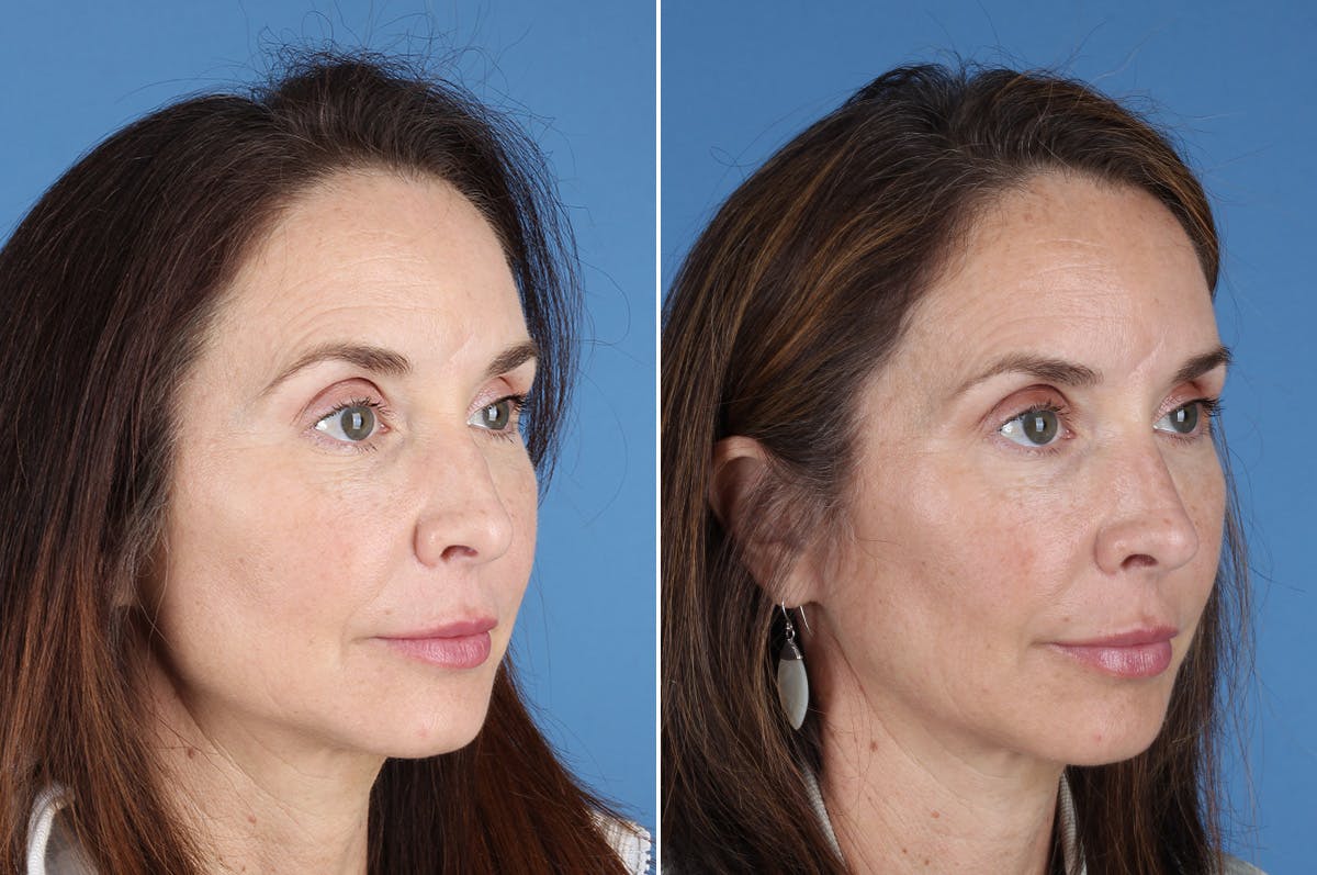 Revision Rhinoplasty Before & After Gallery - Patient 361799 - Image 7