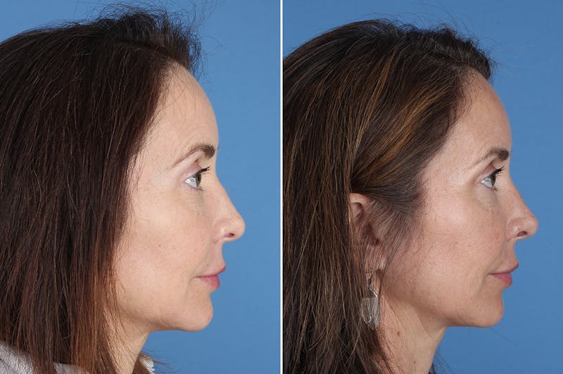 Revision Rhinoplasty Before & After Gallery - Patient 361799 - Image 1