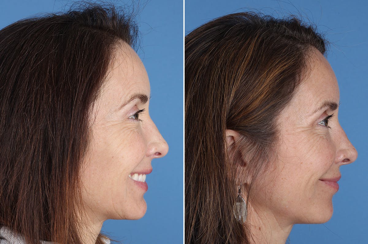 Revision Rhinoplasty Before & After Gallery - Patient 361799 - Image 8
