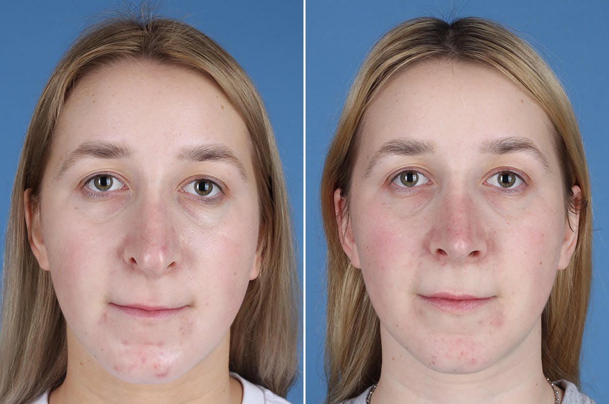 Revision Rhinoplasty Before & After Gallery - Patient 412610 - Image 2