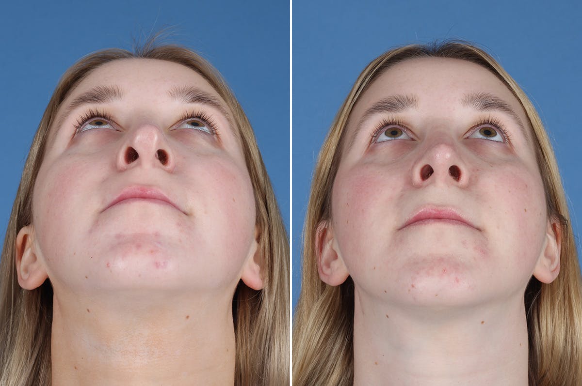 Revision Rhinoplasty Before & After Gallery - Patient 412610 - Image 3
