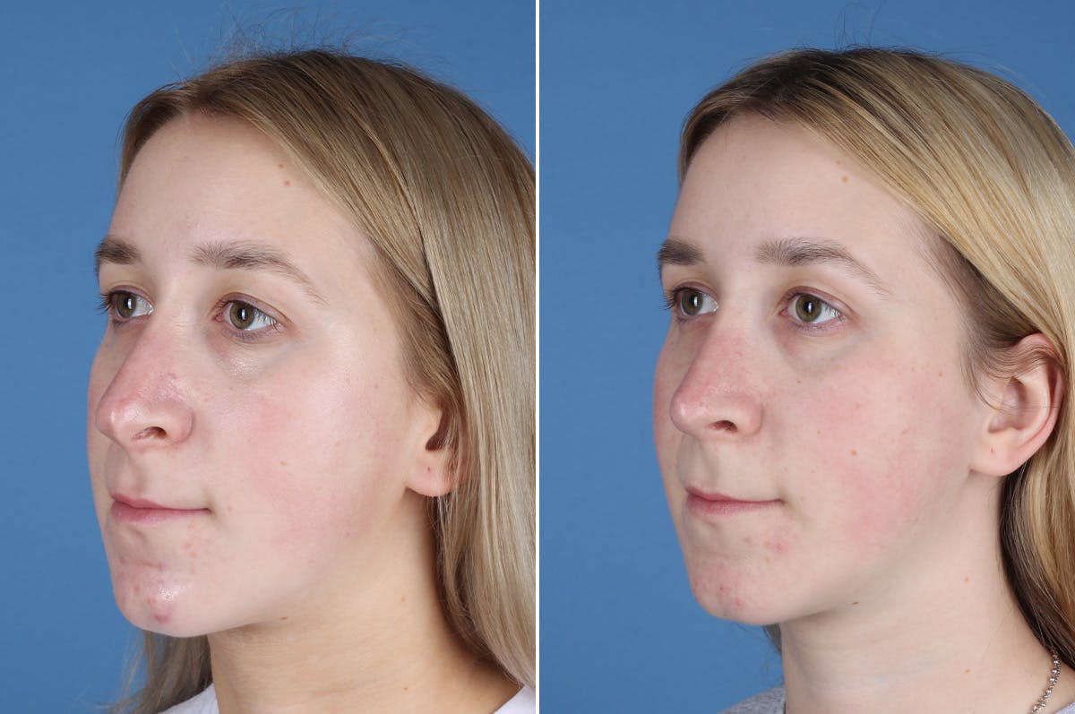 Revision Rhinoplasty Before & After Gallery - Patient 412610 - Image 4