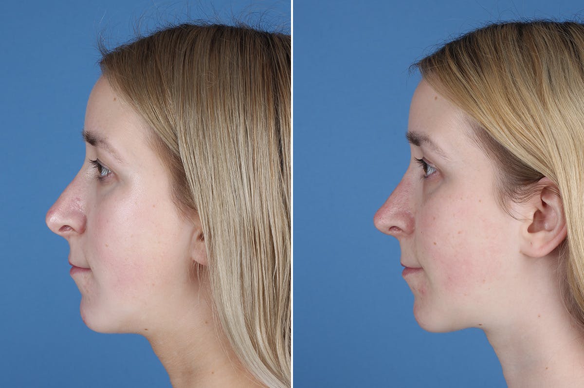 Revision Rhinoplasty Before & After Gallery - Patient 412610 - Image 5