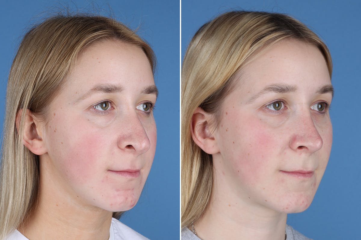 Revision Rhinoplasty Before & After Gallery - Patient 412610 - Image 7