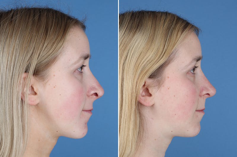 Revision Rhinoplasty Before & After Gallery - Patient 412610 - Image 1