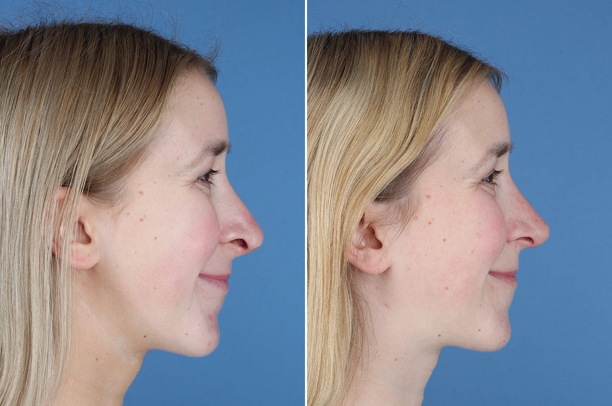 Revision Rhinoplasty Before & After Gallery - Patient 412610 - Image 8