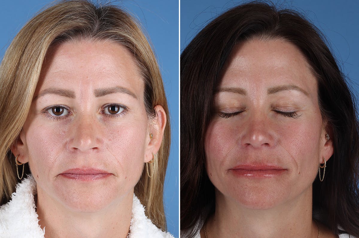 Revision Rhinoplasty Before & After Gallery - Patient 323365 - Image 2