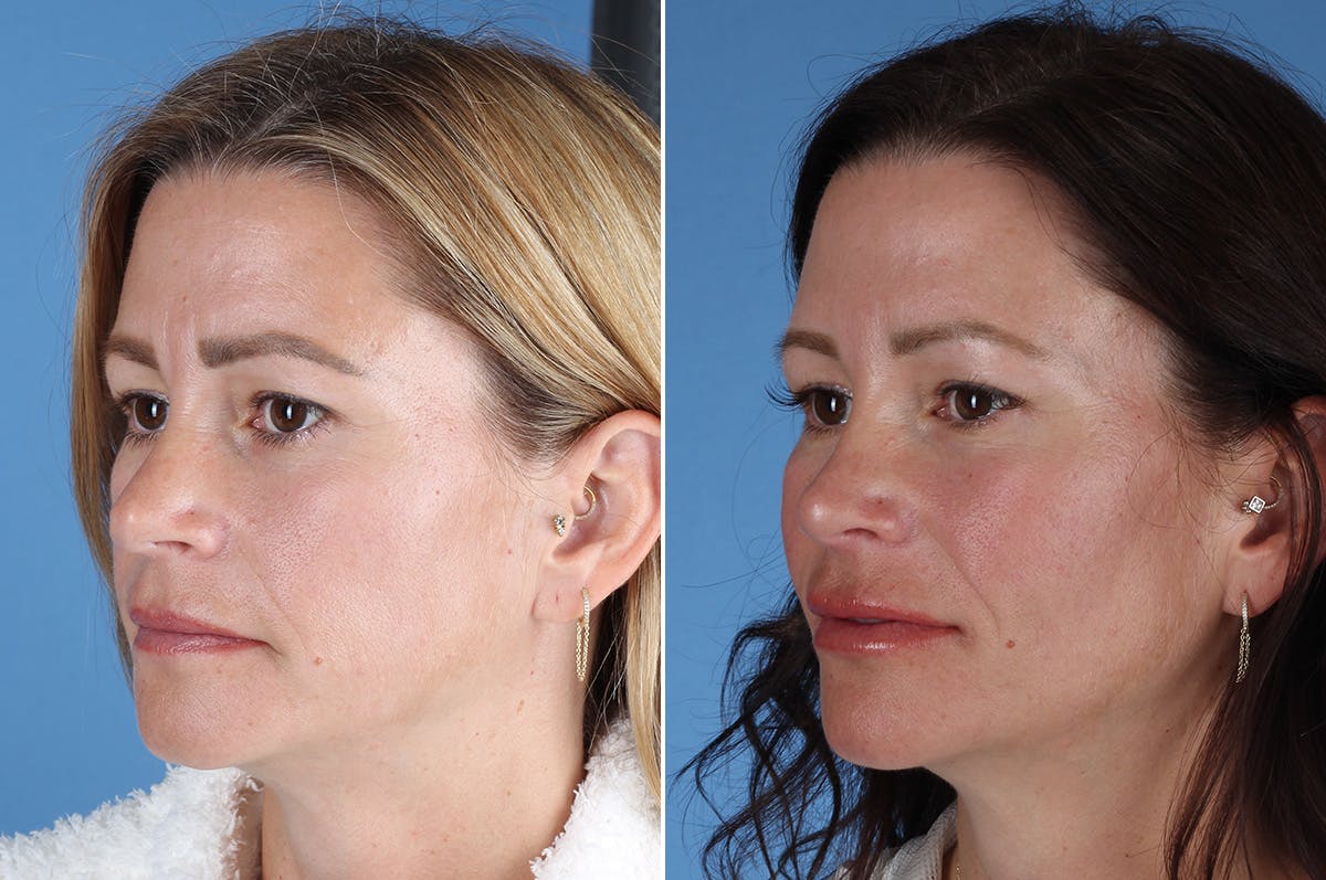 Revision Rhinoplasty Before & After Gallery - Patient 323365 - Image 4