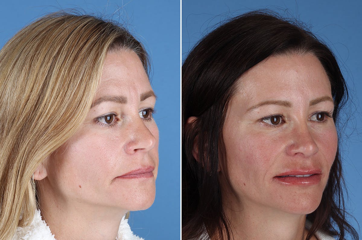 Revision Rhinoplasty Before & After Gallery - Patient 323365 - Image 7