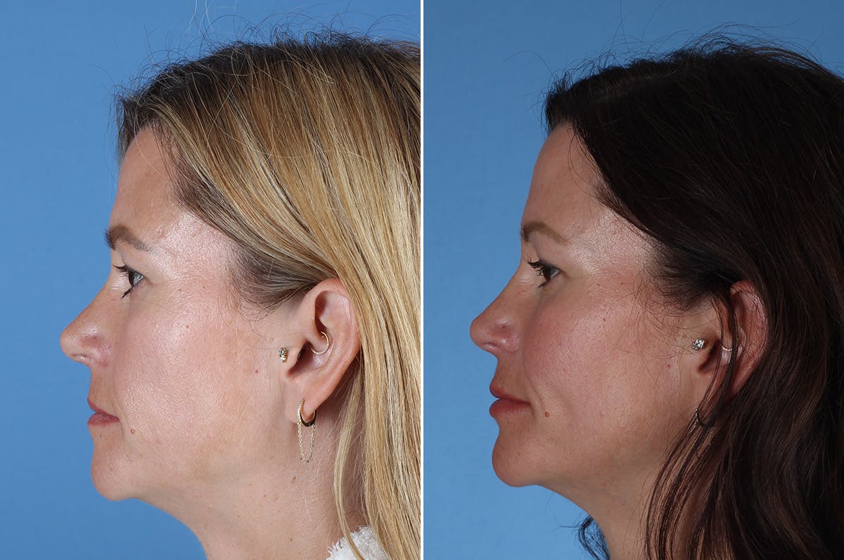 Revision Rhinoplasty Before & After Gallery - Patient 323365 - Image 5