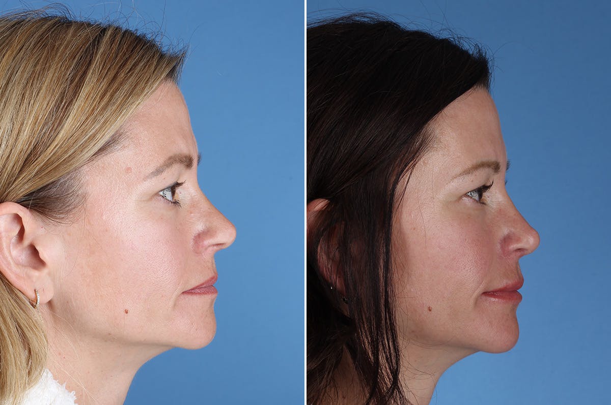 Revision Rhinoplasty Before & After Gallery - Patient 323365 - Image 1