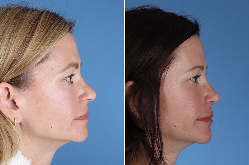 Revision Rhinoplasty Before & After Gallery - Patient 323365 - Image 1