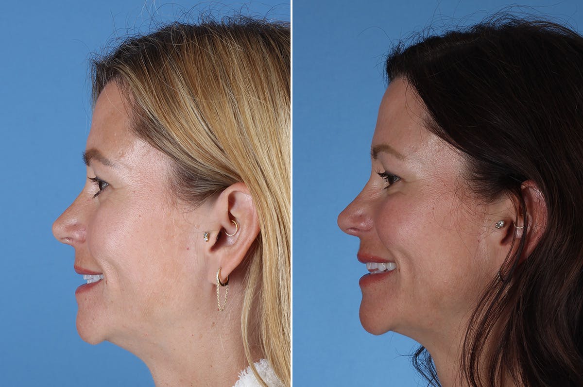 Revision Rhinoplasty Before & After Gallery - Patient 323365 - Image 6