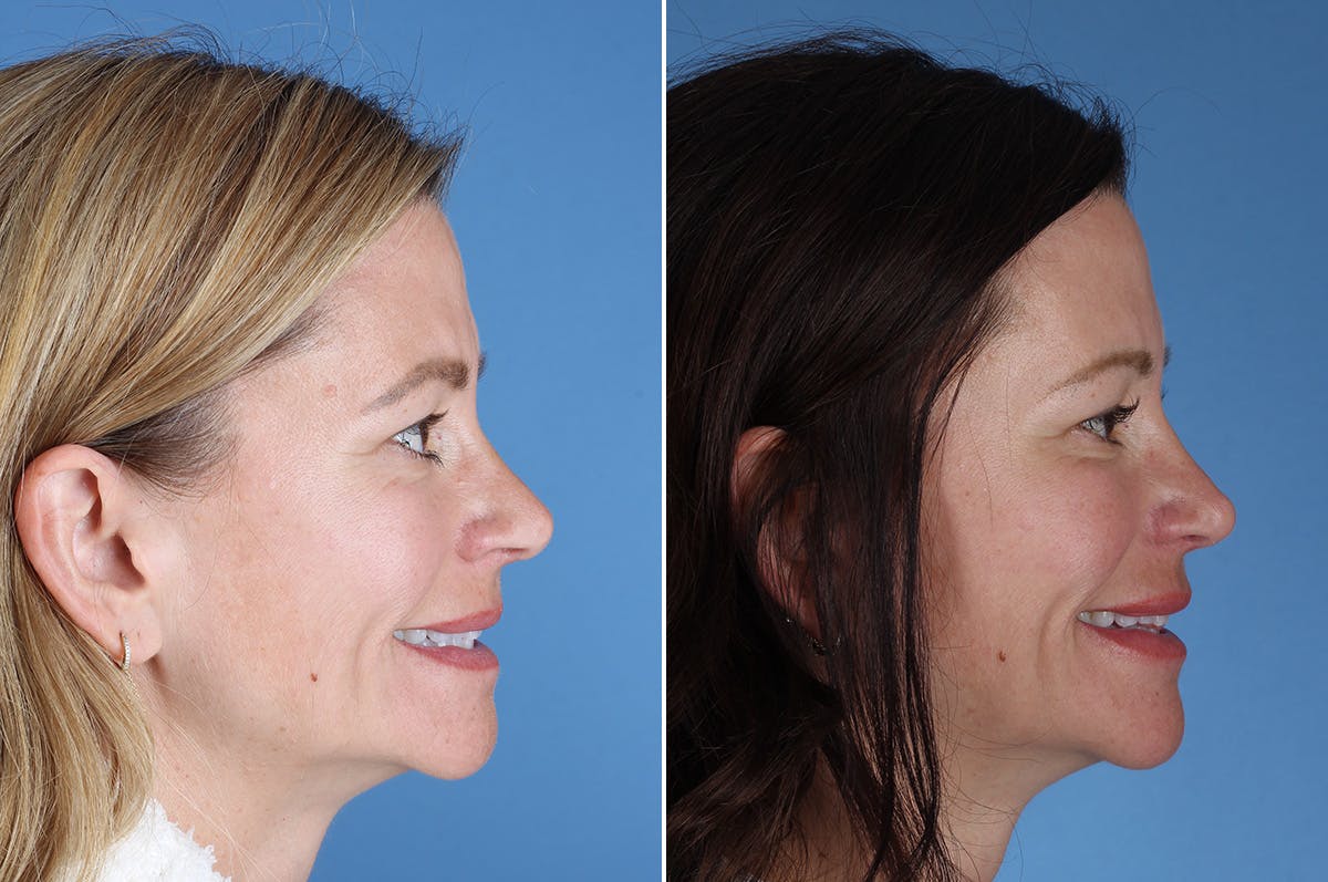 Revision Rhinoplasty Before & After Gallery - Patient 323365 - Image 8
