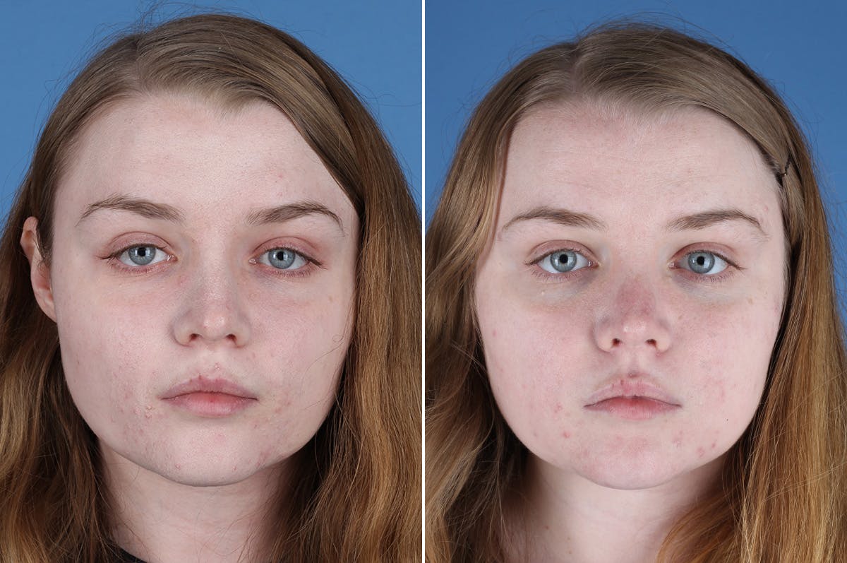 Revision Rhinoplasty Before & After Gallery - Patient 405951 - Image 2