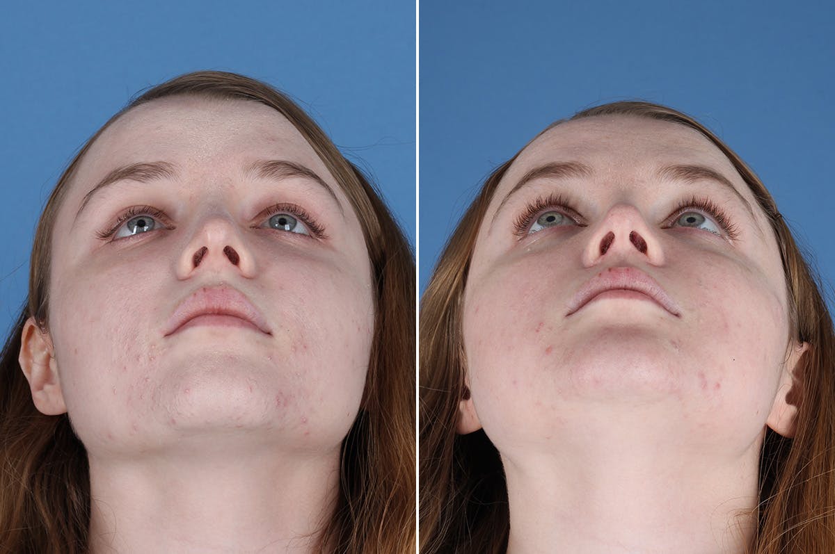 Revision Rhinoplasty Before & After Gallery - Patient 405951 - Image 3