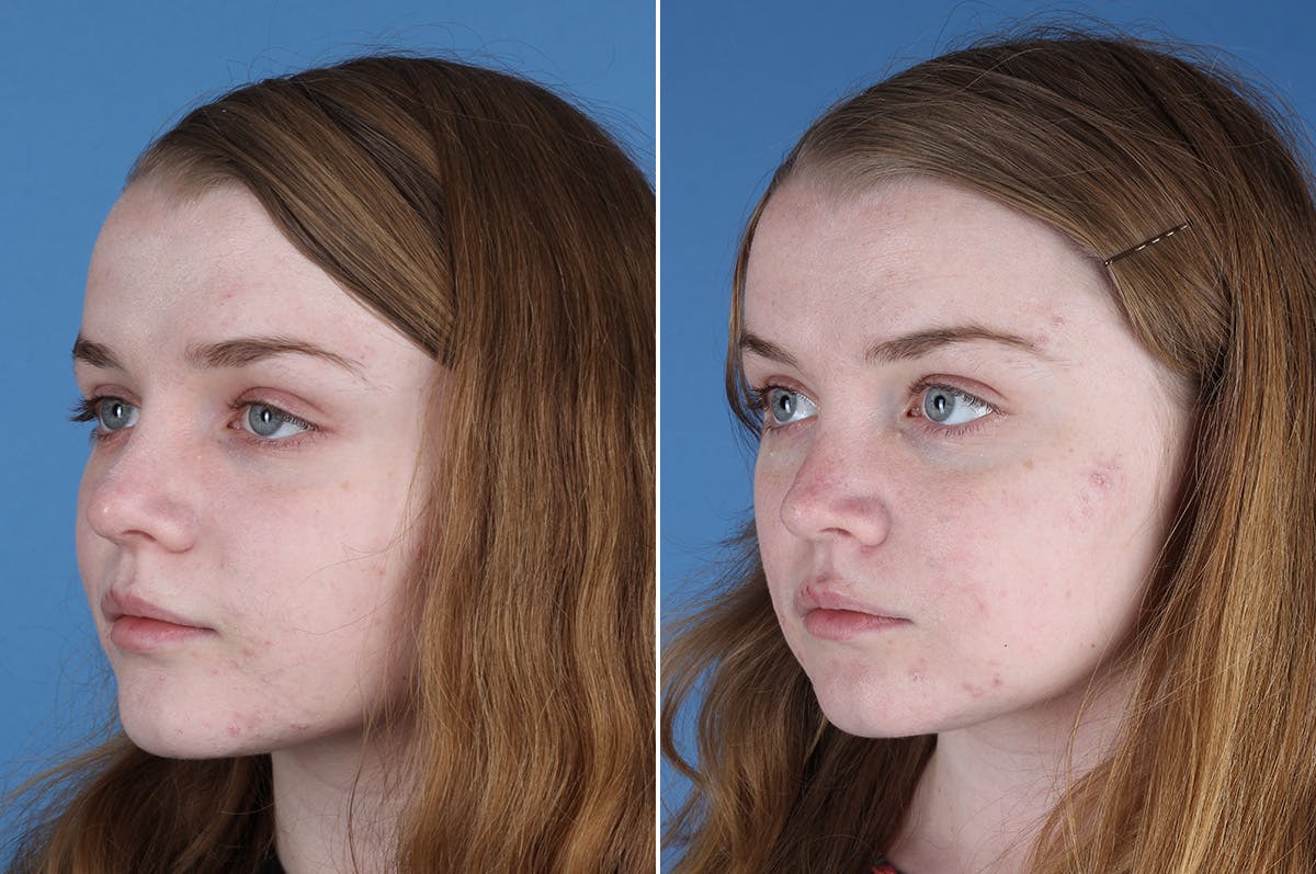 Revision Rhinoplasty Before & After Gallery - Patient 405951 - Image 4