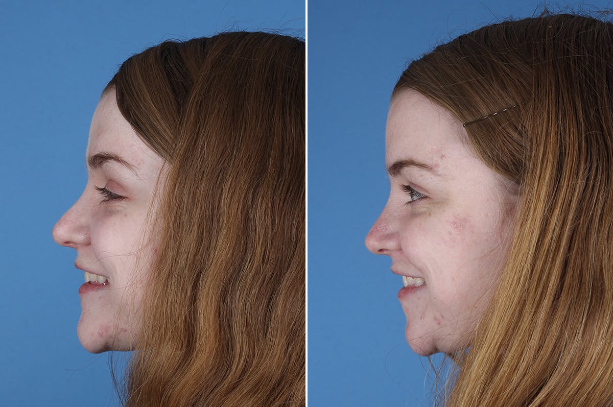 Revision Rhinoplasty Before & After Gallery - Patient 405951 - Image 6