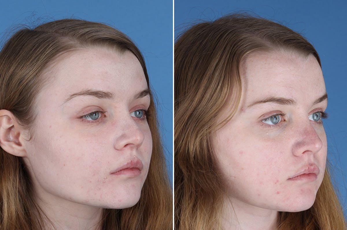 Revision Rhinoplasty Before & After Gallery - Patient 405951 - Image 7