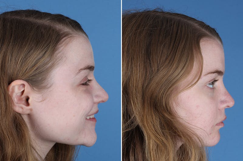 Revision Rhinoplasty Before & After Gallery - Patient 405951 - Image 1
