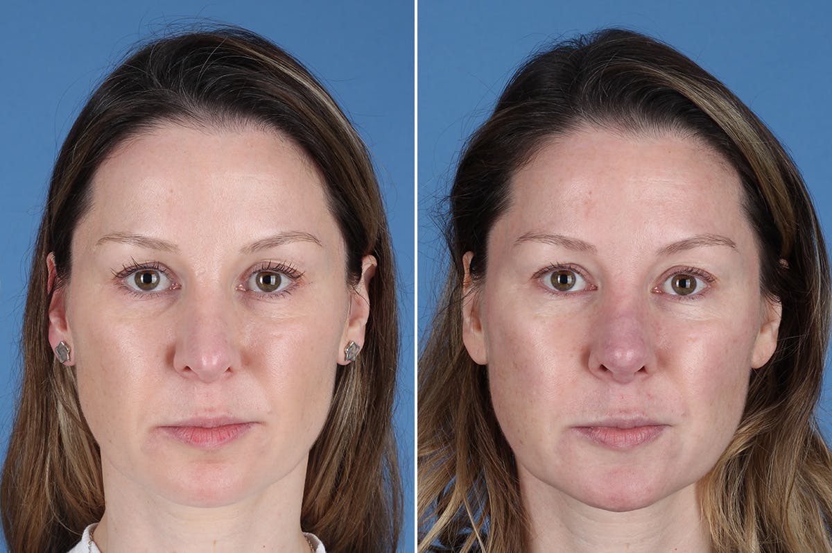 Revision Rhinoplasty Before & After Gallery - Patient 229086 - Image 2