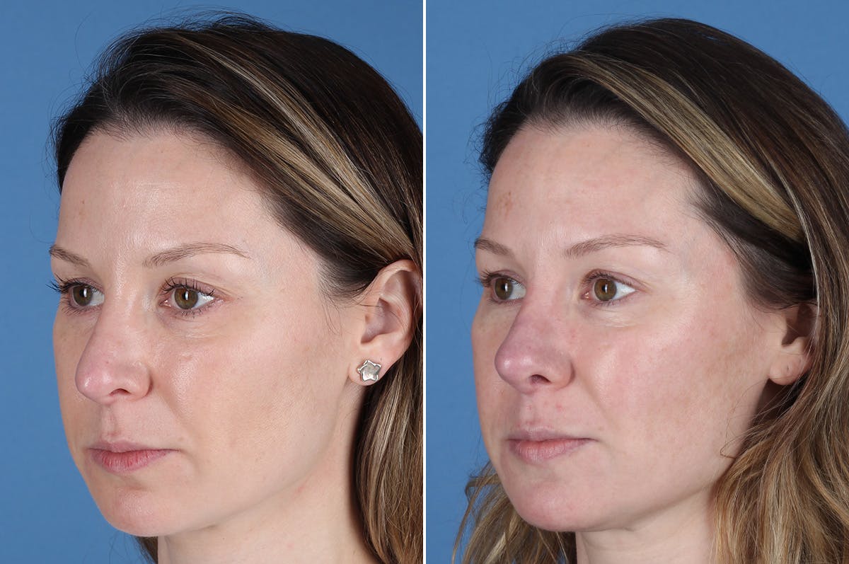Revision Rhinoplasty Before & After Gallery - Patient 229086 - Image 3