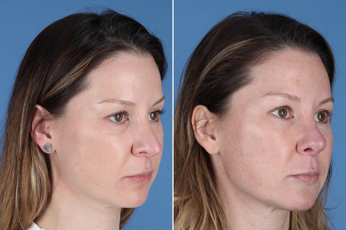 Revision Rhinoplasty Before & After Gallery - Patient 229086 - Image 6