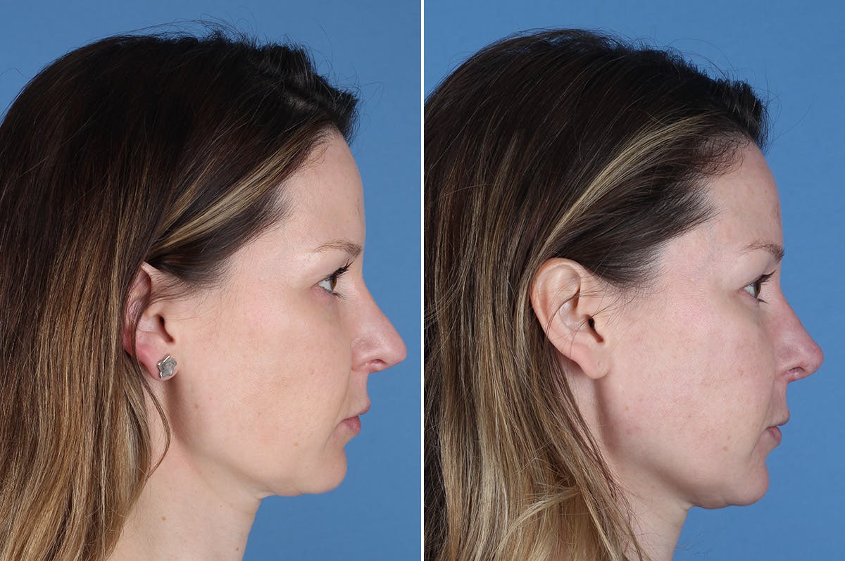 Revision Rhinoplasty Before & After Gallery - Patient 229086 - Image 7