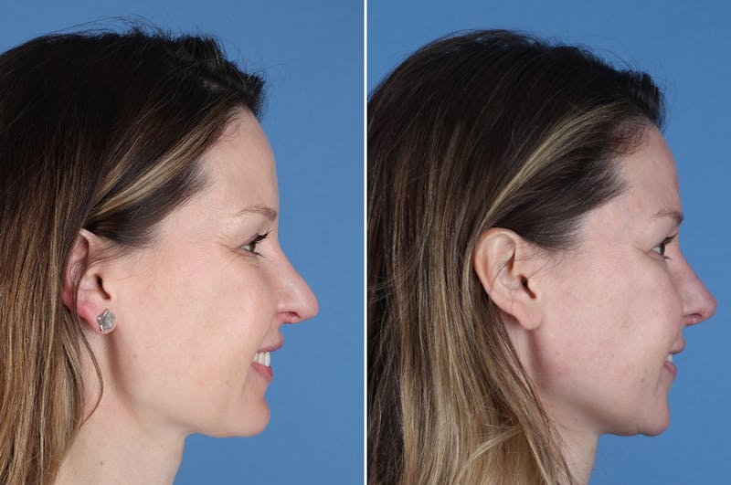 Revision Rhinoplasty Before & After Gallery - Patient 229086 - Image 1