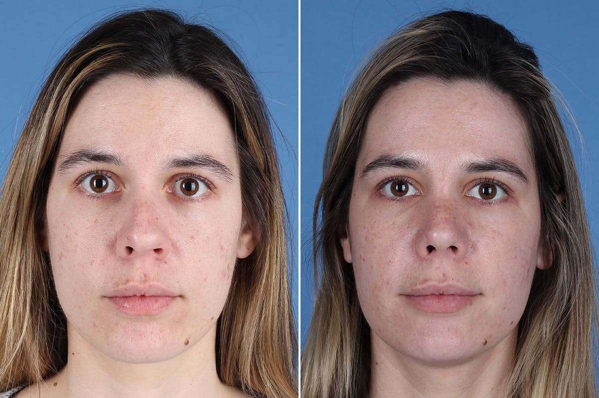 Revision Rhinoplasty Before & After Gallery - Patient 102649 - Image 2