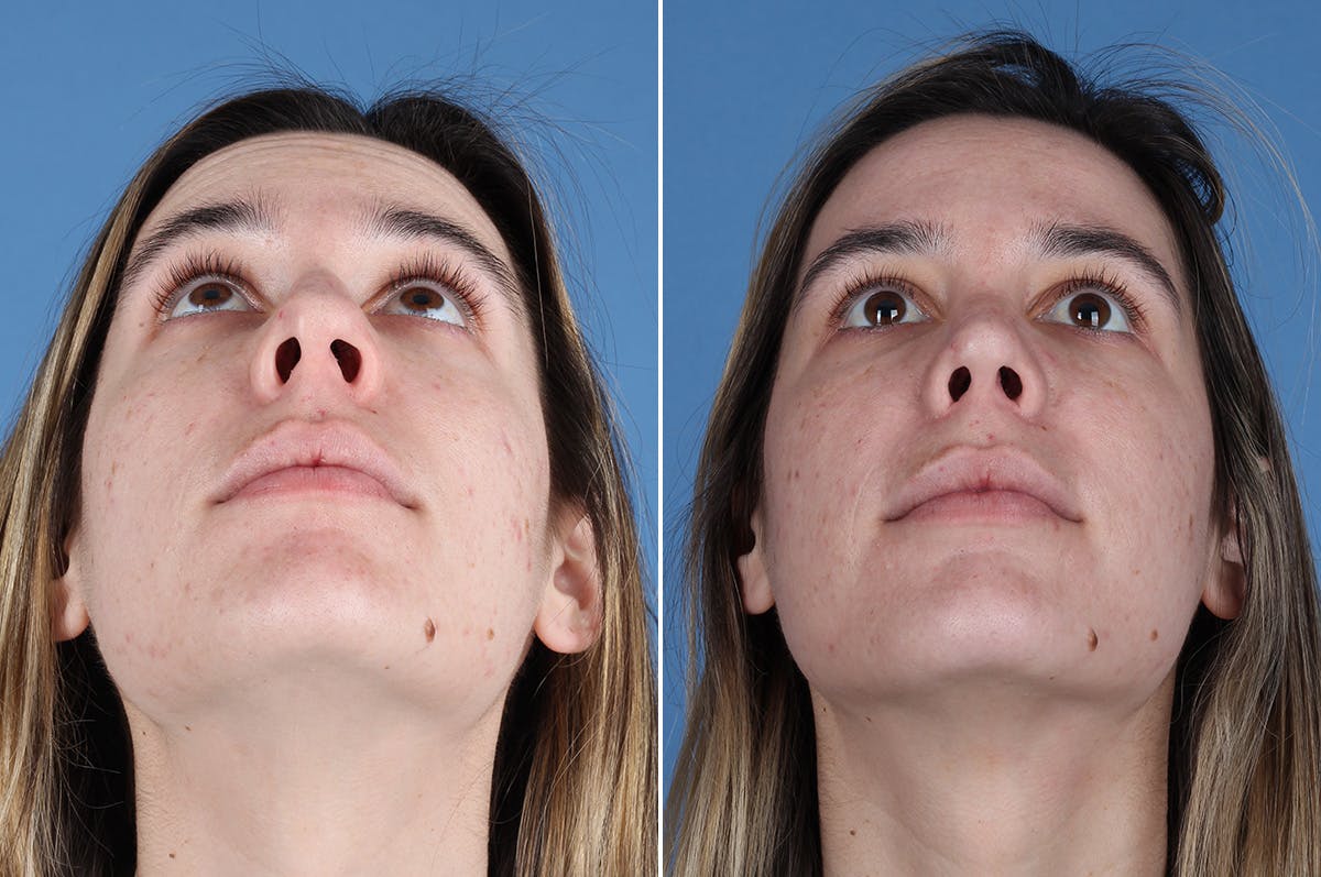 Revision Rhinoplasty Before & After Gallery - Patient 102649 - Image 3