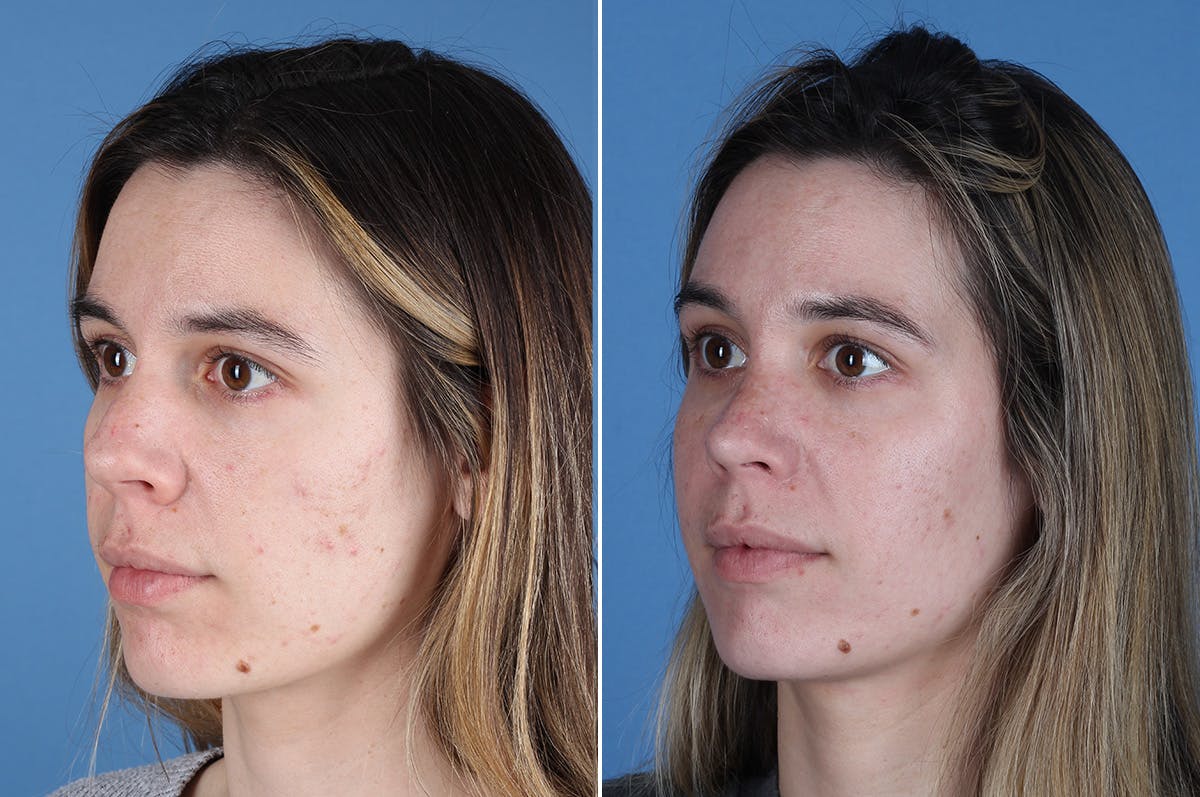 Revision Rhinoplasty Before & After Gallery - Patient 102649 - Image 4