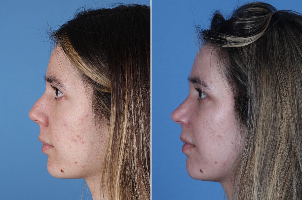 Revision Rhinoplasty Before & After Gallery - Patient 102649 - Image 5