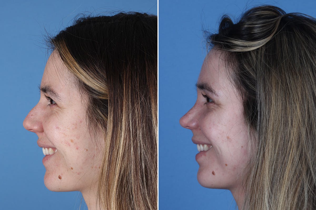 Revision Rhinoplasty Before & After Gallery - Patient 102649 - Image 6