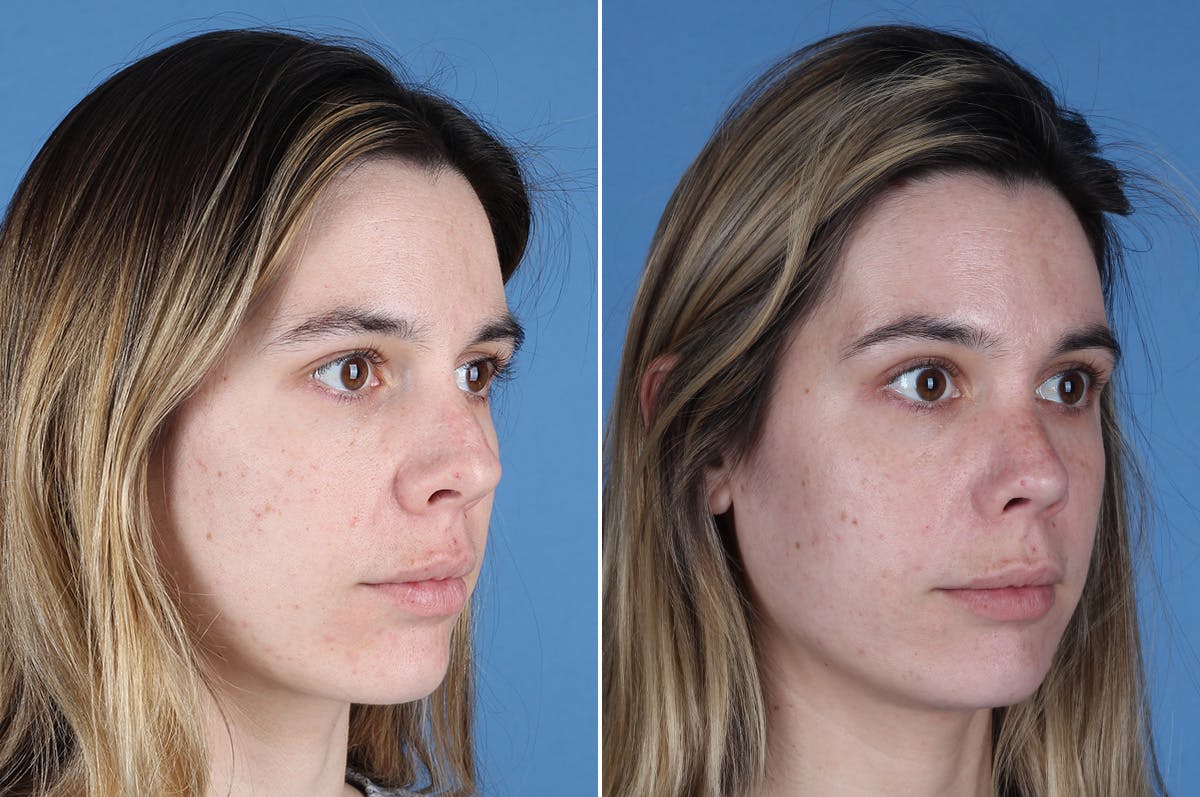 Revision Rhinoplasty Before & After Gallery - Patient 102649 - Image 7