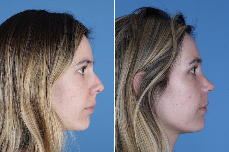 Revision Rhinoplasty Before & After Gallery - Patient 102649 - Image 1