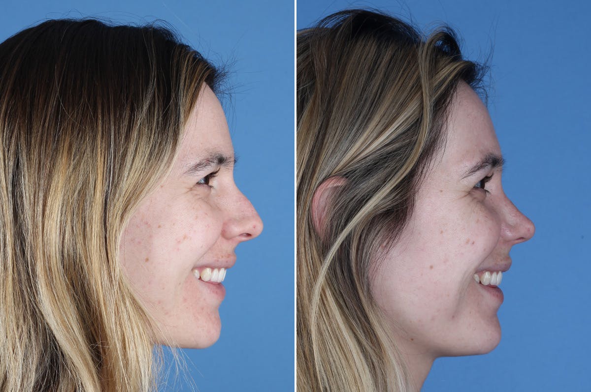 Revision Rhinoplasty Before & After Gallery - Patient 102649 - Image 8