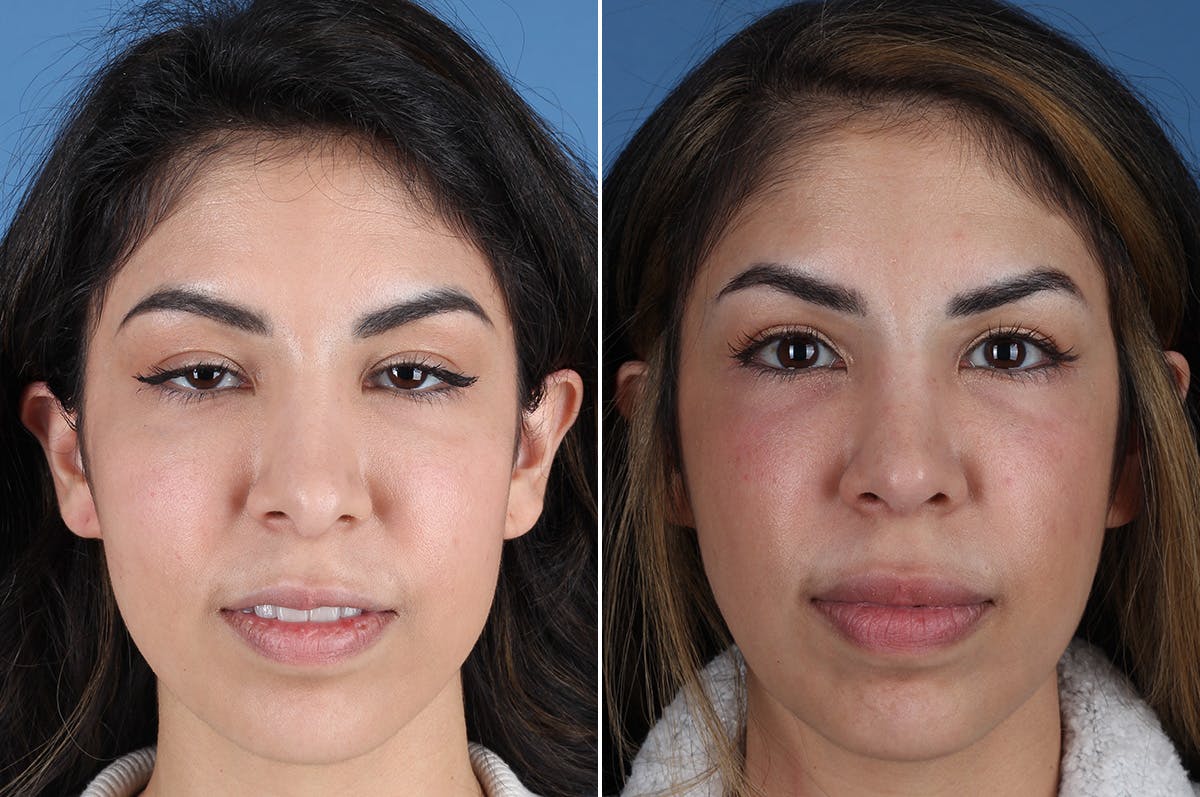 Revision Rhinoplasty Before & After Gallery - Patient 326889 - Image 2