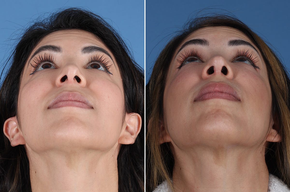 Revision Rhinoplasty Before & After Gallery - Patient 326889 - Image 3
