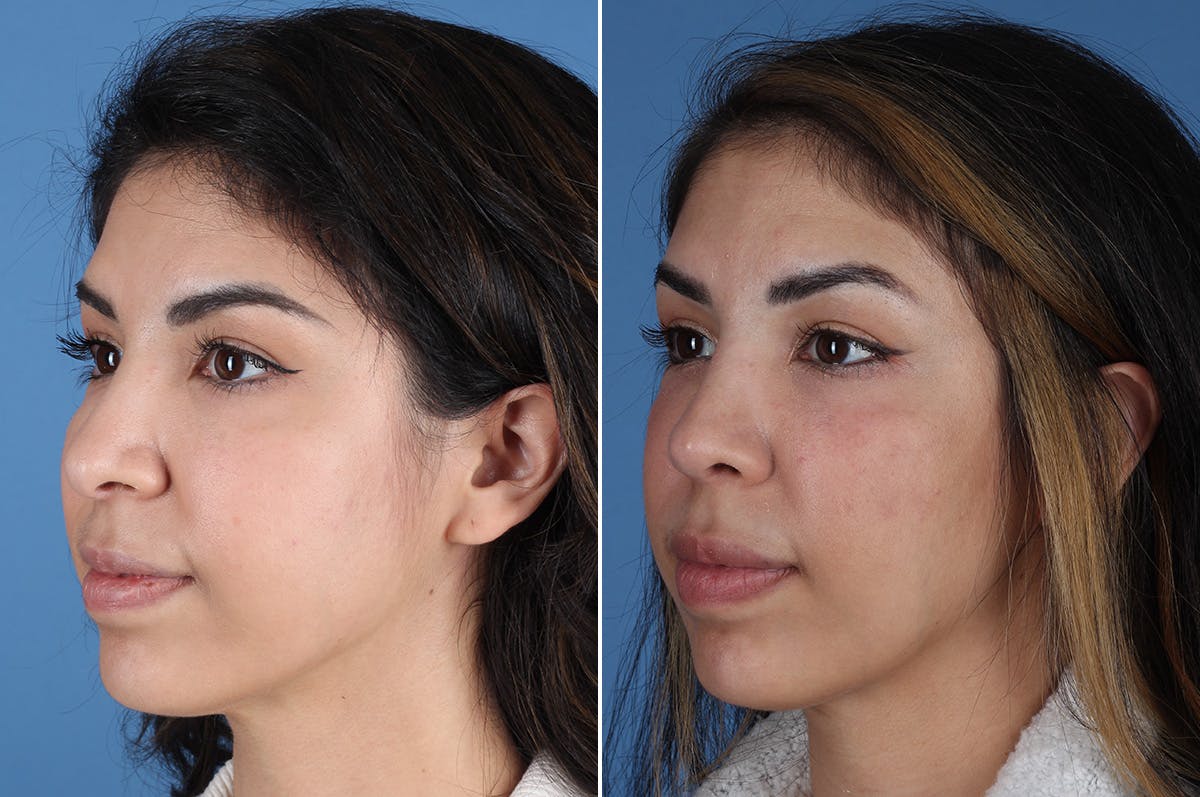 Revision Rhinoplasty Before & After Gallery - Patient 326889 - Image 4