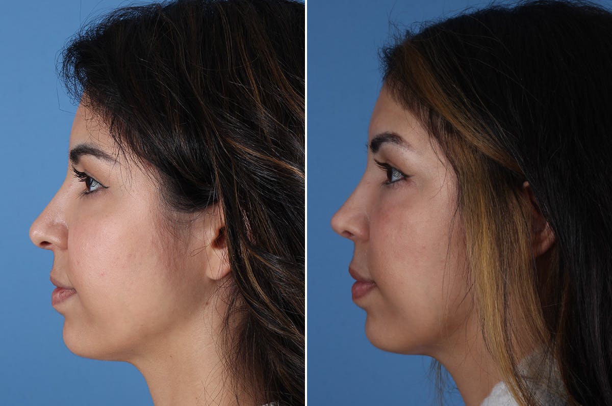 Revision Rhinoplasty Before & After Gallery - Patient 326889 - Image 5