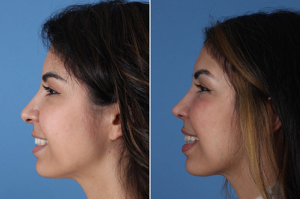 Revision Rhinoplasty Before & After Gallery - Patient 326889 - Image 6