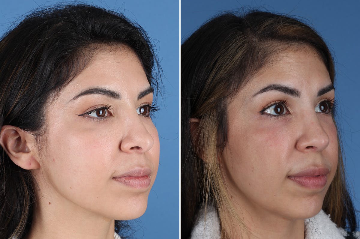 Revision Rhinoplasty Before & After Gallery - Patient 326889 - Image 7