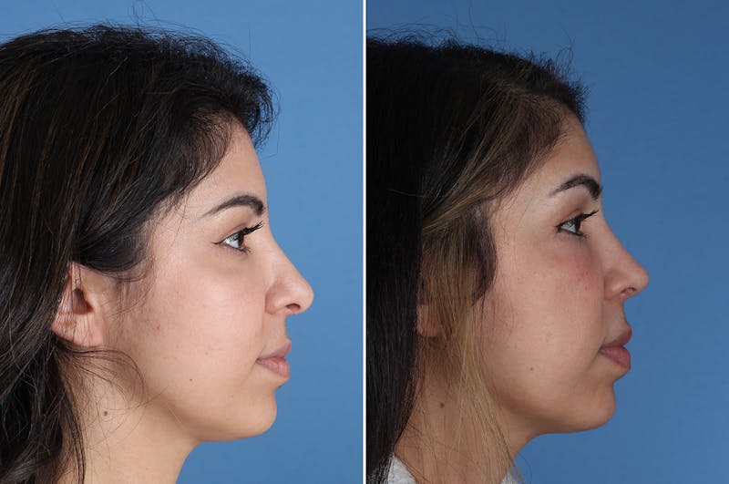 Revision Rhinoplasty Before & After Gallery - Patient 326889 - Image 1
