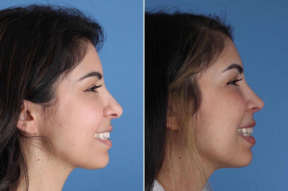 Revision Rhinoplasty Before & After Gallery - Patient 326889 - Image 8
