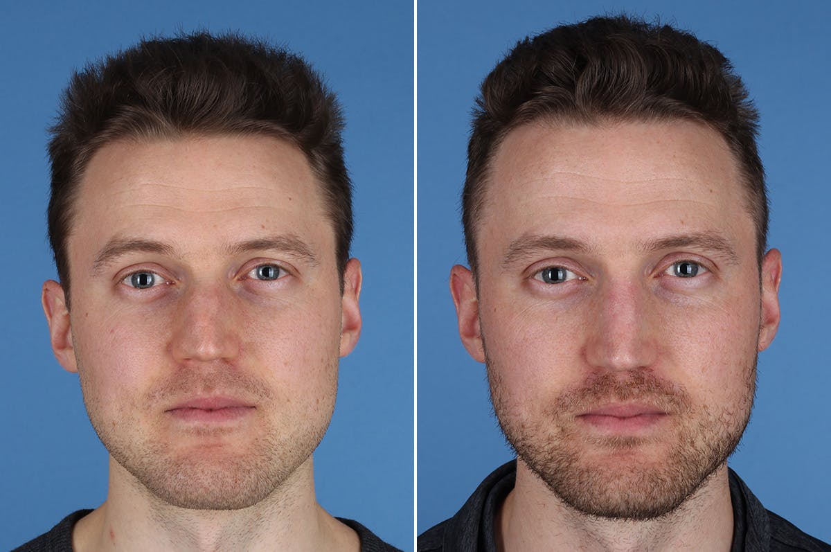 Revision Rhinoplasty Before & After Gallery - Patient 169283 - Image 2